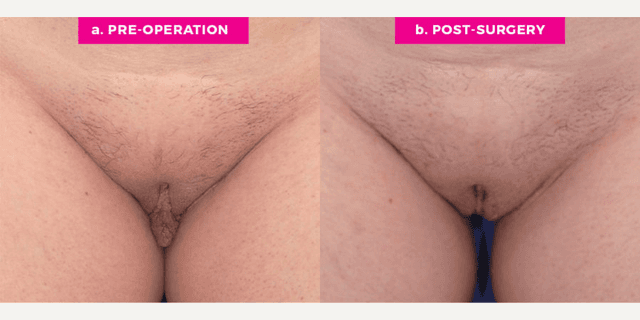 Vaginal Rejuvenation procedure image