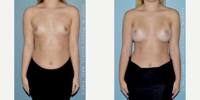 Mommy Makeover procedure image