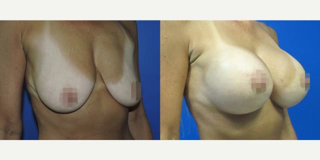 Breast Augmentation procedure image