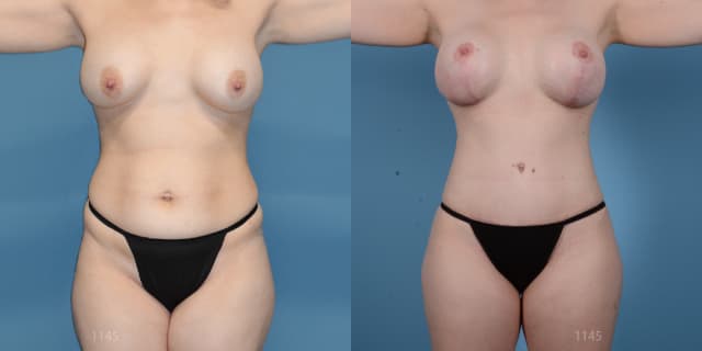 Breast Augmentation procedure image
