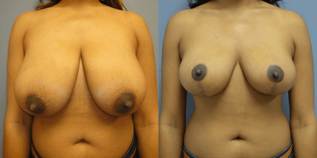 Breast Augmentation procedure image