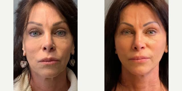 Rhinoplasty (Nose Job) procedure image