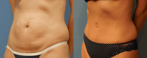 Breast Augmentation with Lift procedure image