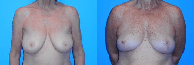 Breast Augmentation procedure image