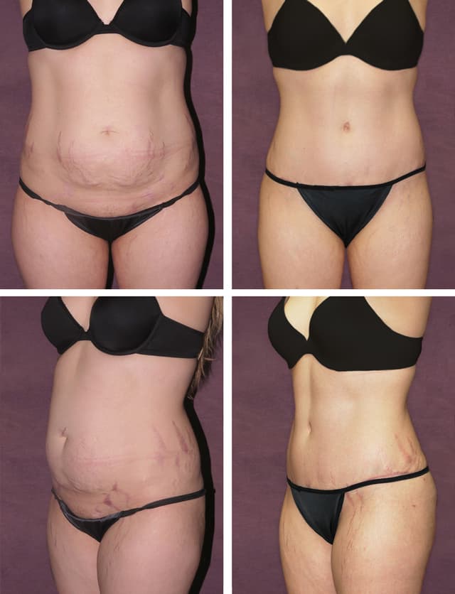 Lipo 360 procedure image