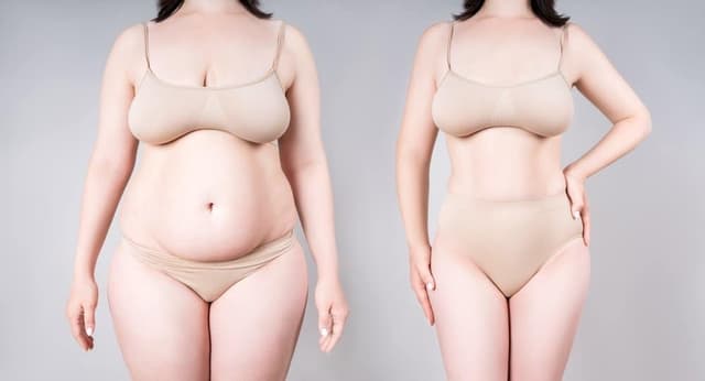 Mommy Makeover procedure image