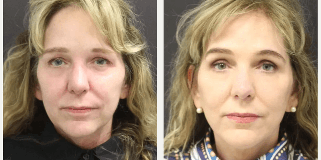 Facelift procedure image