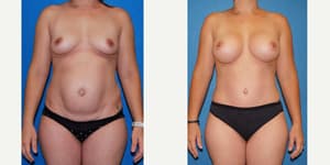 Tummy Tuck (Abdominoplasty) procedure image