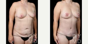 Mommy Makeover procedure image