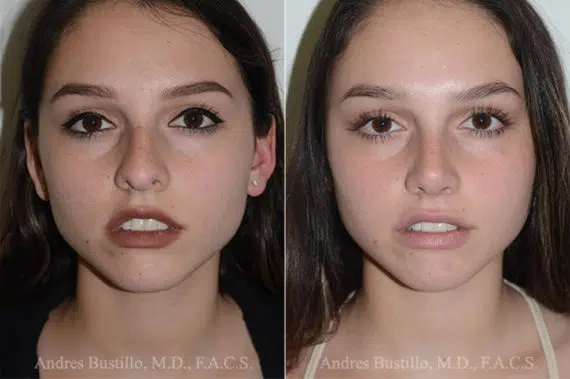 Rhinoplasty (Nose Job) procedure image