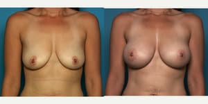 Skin Tightening procedure image