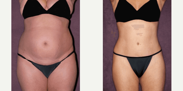 Skin Tightening procedure image