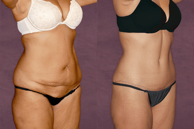 Tummy Tuck (Abdominoplasty) procedure image
