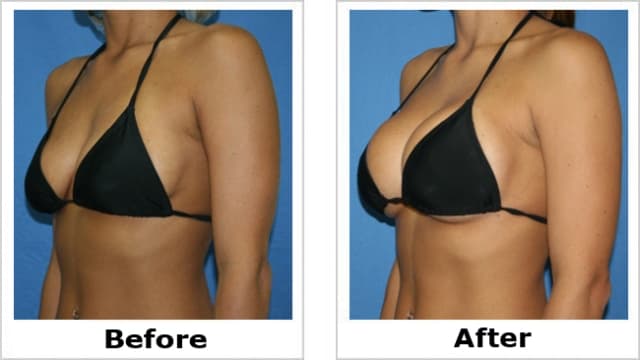 Breast Augmentation procedure image
