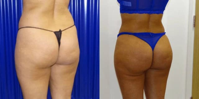 Brazilian Butt Lift (BBL) procedure image