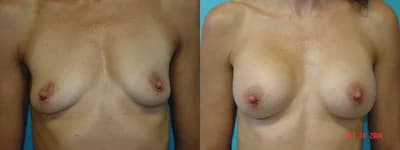 Mommy Makeover procedure image