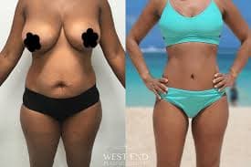 Liposuction procedure image