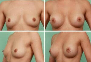 Liposuction procedure image