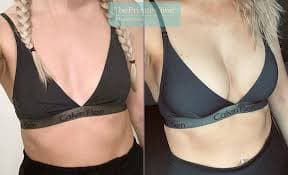 Breast Augmentation procedure image