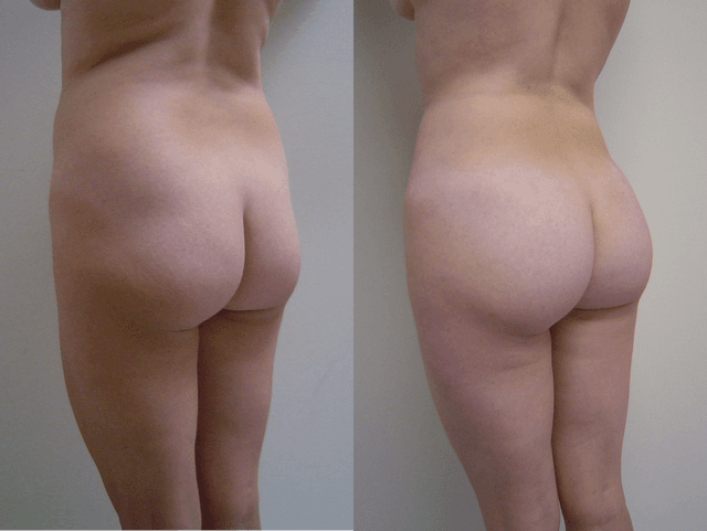 Brazilian Butt Lift (BBL) procedure image