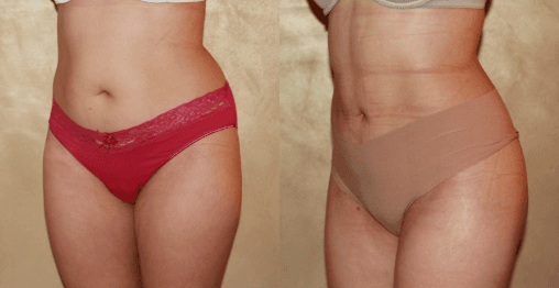 Tummy Tuck (Abdominoplasty) procedure image