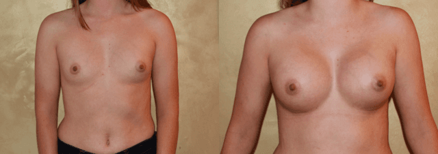 Breast Lift (Mastopexy) procedure image