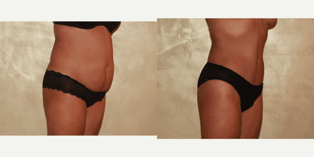 Liposuction procedure image