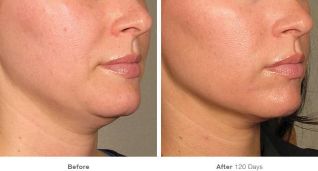 Skin Tightening procedure image