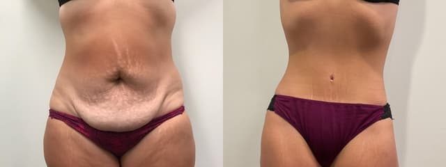 Tummy Tuck (Abdominoplasty) procedure image