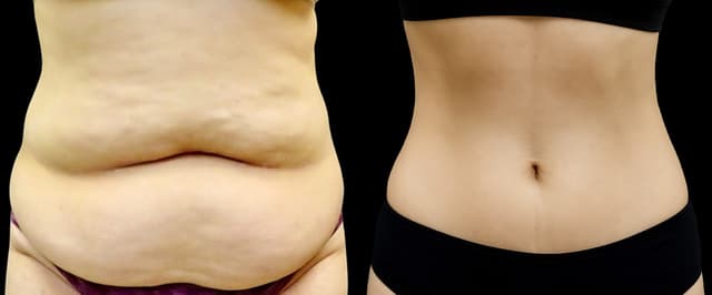 Tummy Tuck (Abdominoplasty) procedure image