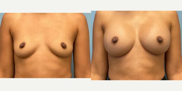 Breast Implants (Saline/Silicone) procedure image