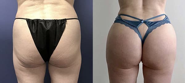 Mommy Makeover procedure image