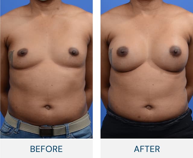 Breast Augmentation procedure image