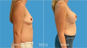 Breast Augmentation procedure image