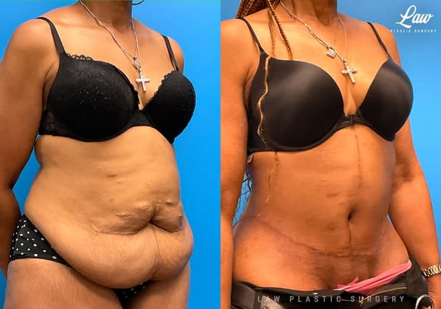 Tummy Tuck (Abdominoplasty) procedure image