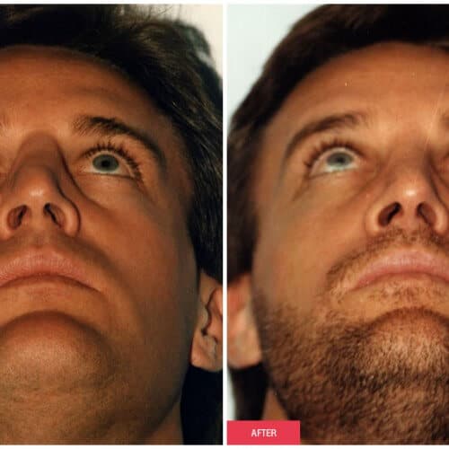 Rhinoplasty (Nose Job) procedure image