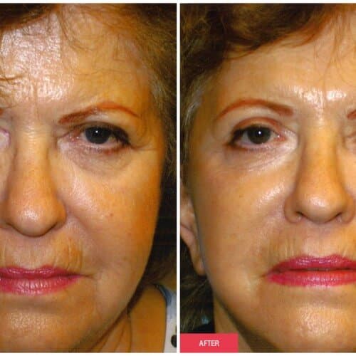 Facelift procedure image