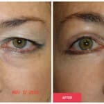 Eyelid Surgery (Blepharoplasty) procedure image