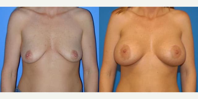 Breast Augmentation procedure image