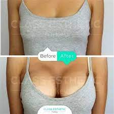 Breast Augmentation procedure image