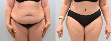 Tummy Tuck (Abdominoplasty) procedure image