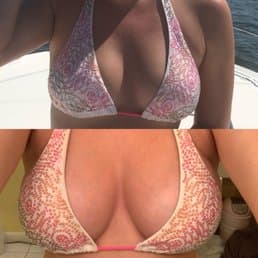 Breast Augmentation procedure image