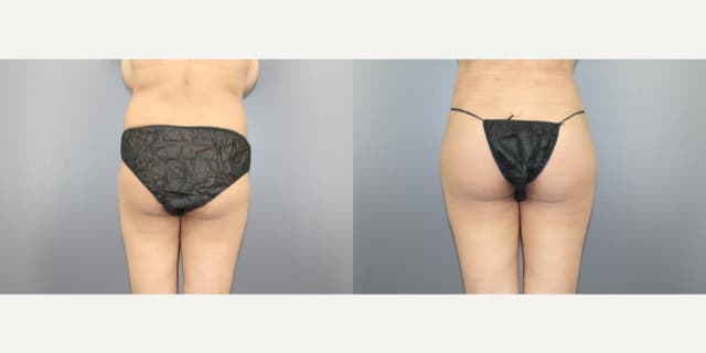 Brazilian Butt Lift (BBL) procedure image