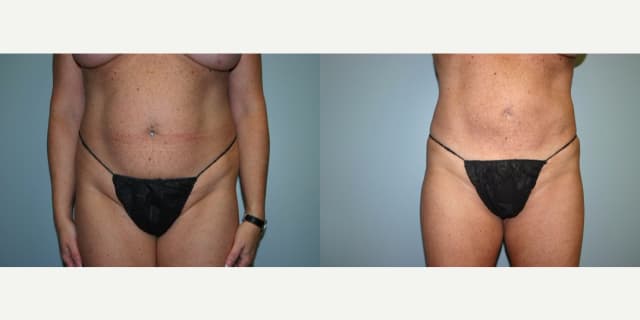 Liposuction procedure image