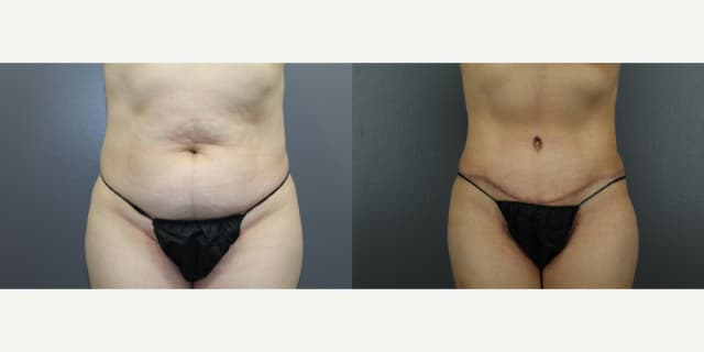 Tummy Tuck (Abdominoplasty) procedure image
