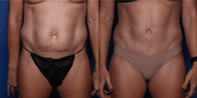 Tummy Tuck (Abdominoplasty) procedure image