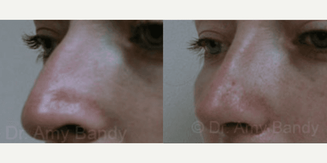 Rhinoplasty (Nose Job) procedure image