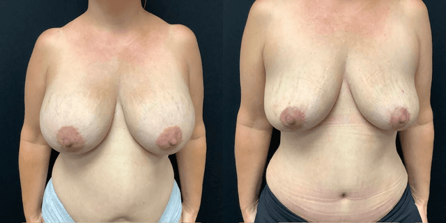 Breast Lift (Mastopexy) procedure image