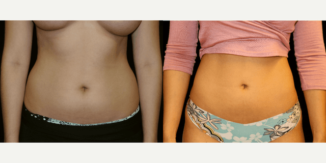 Breast Augmentation procedure image
