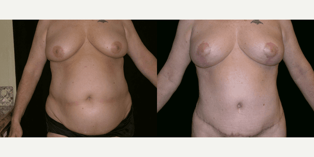 Tummy Tuck (Abdominoplasty) procedure image
